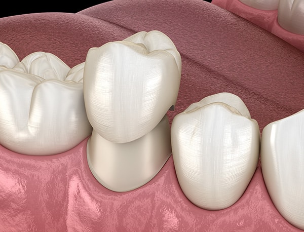 Tooth Colored Crowns